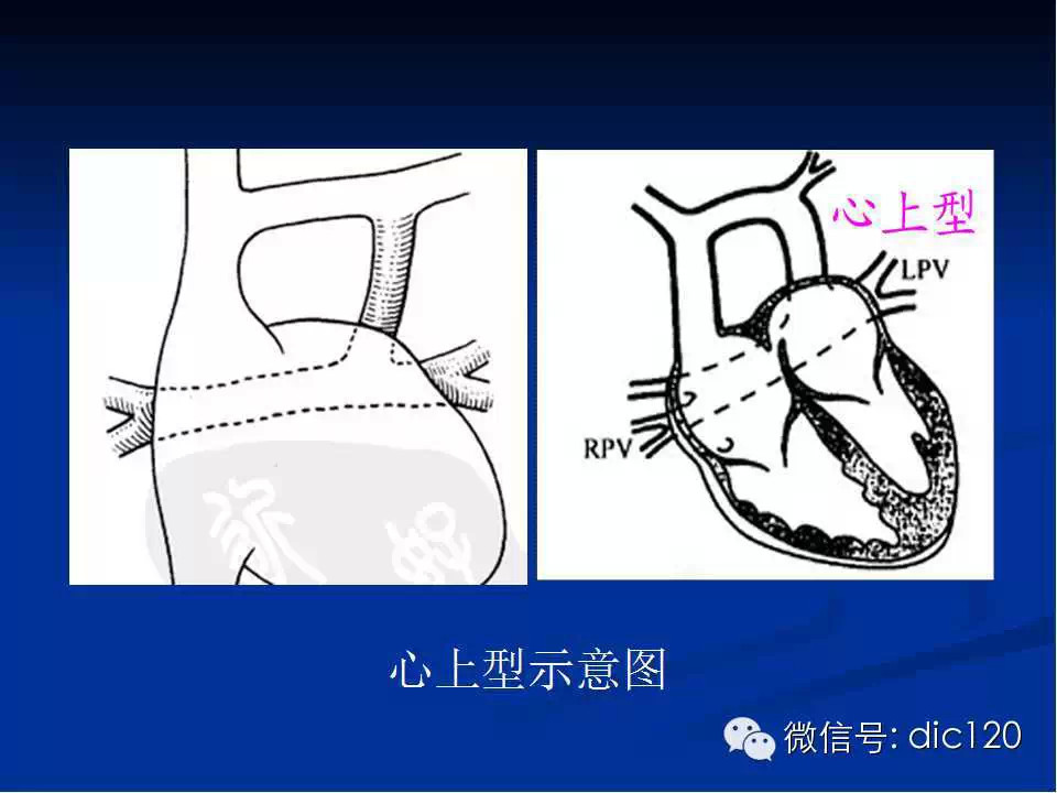 肺静脉畸形引流