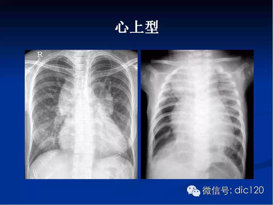 肺静脉畸形引流
