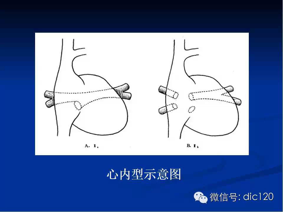 肺静脉畸形引流