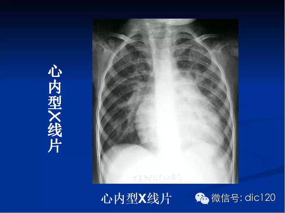 肺静脉畸形引流