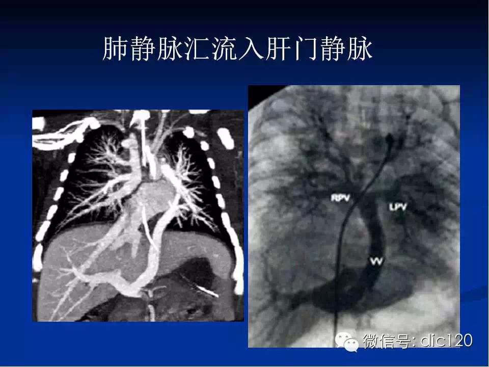 肺静脉畸形引流