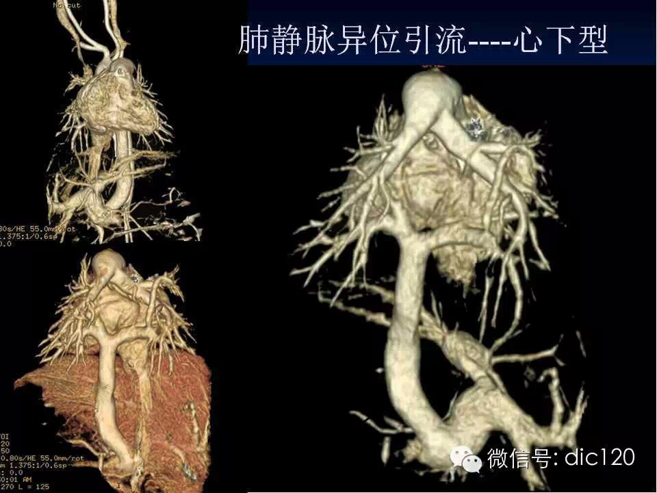 肺静脉畸形引流