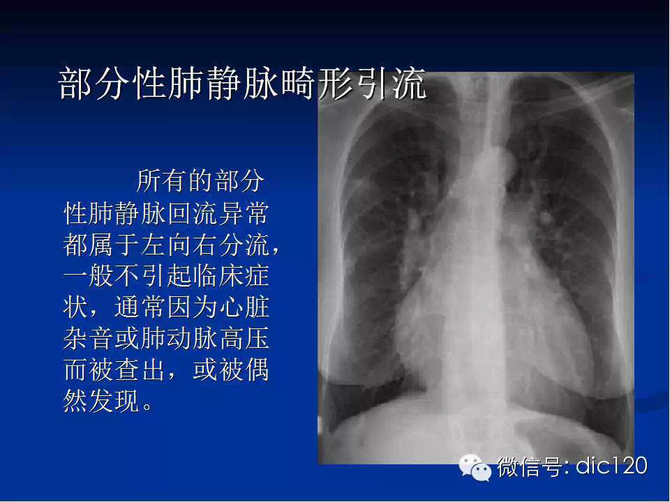 肺静脉畸形引流