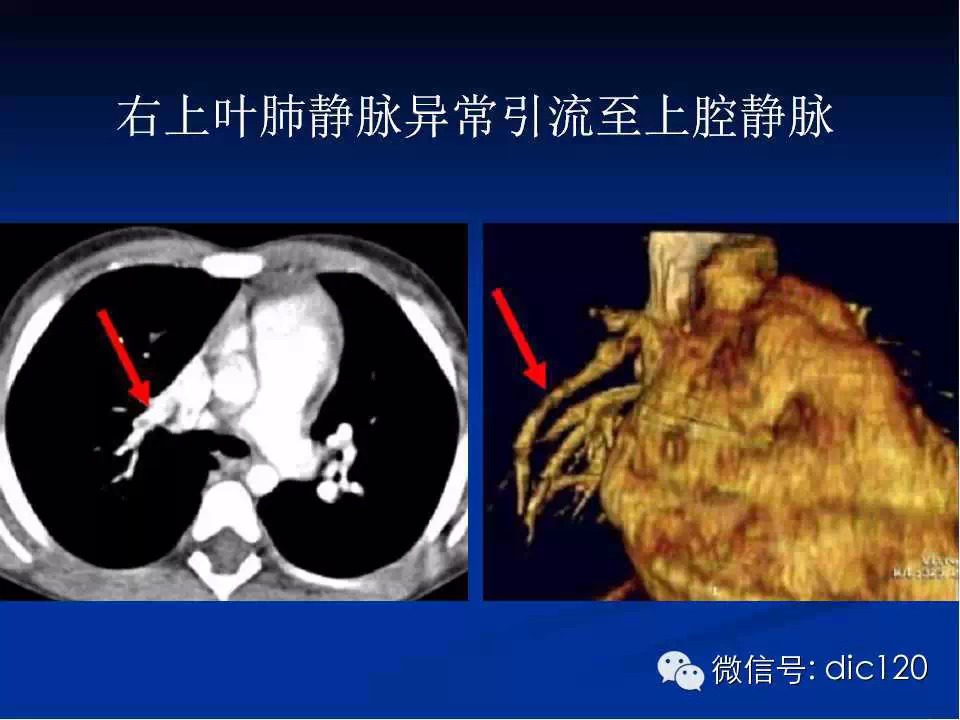 肺静脉畸形引流