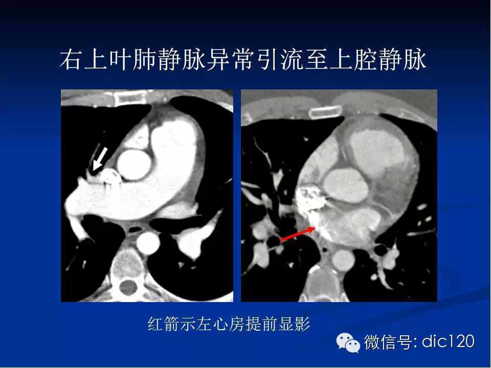 肺静脉畸形引流