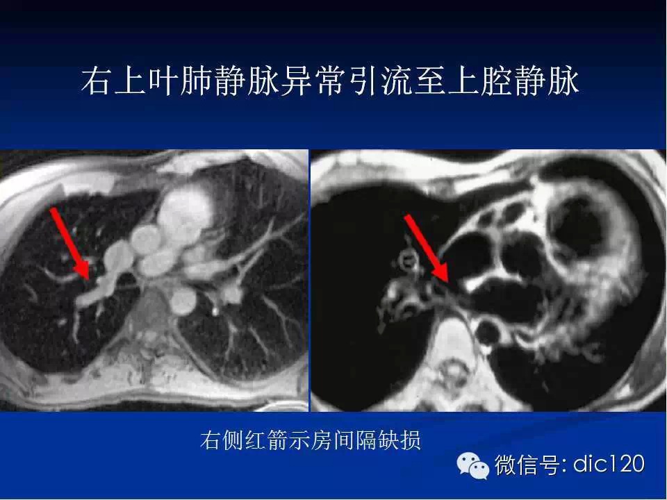 肺静脉畸形引流