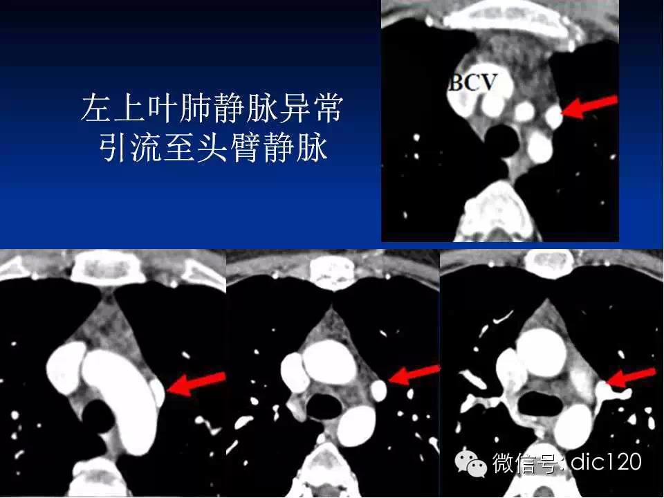 肺静脉畸形引流