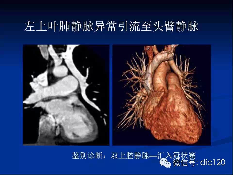 肺静脉畸形引流