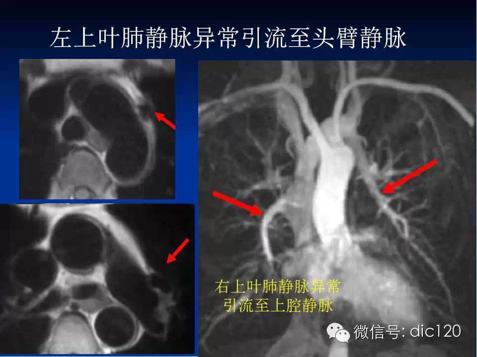 肺静脉畸形引流