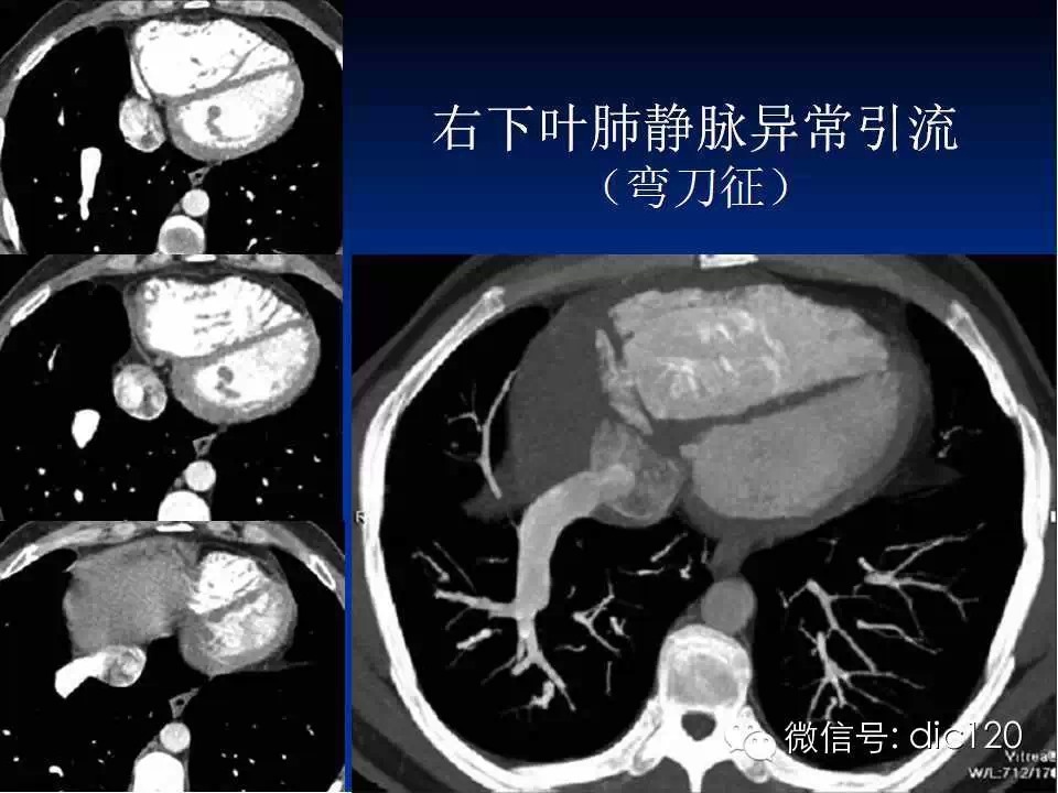 肺静脉畸形引流