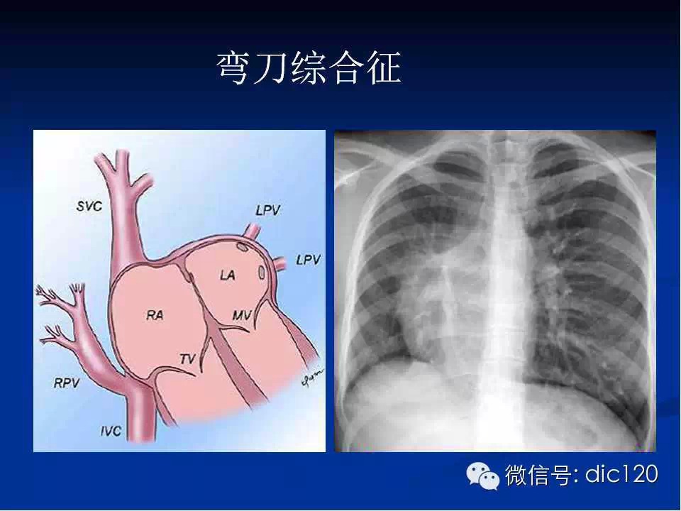 肺静脉畸形引流