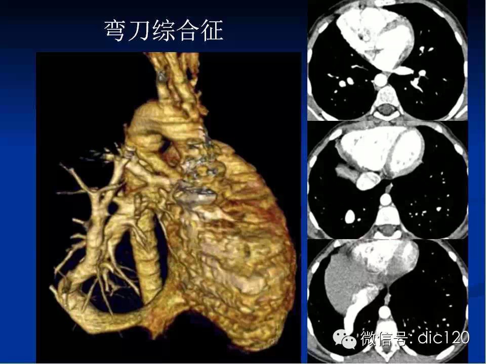 肺静脉畸形引流