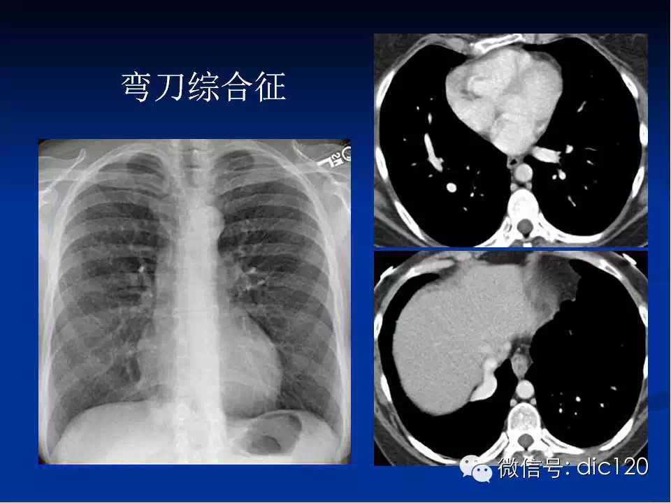 肺静脉畸形引流