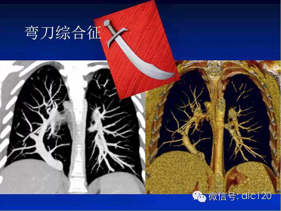 肺静脉畸形引流