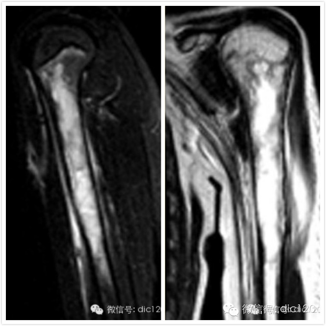 【病例】非骨化性纤维瘤一例影像诊断分析 【病例】非骨化性纤维瘤一例影像诊断分析