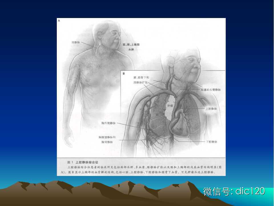 上腔静脉综合征影像诊断及介入治疗