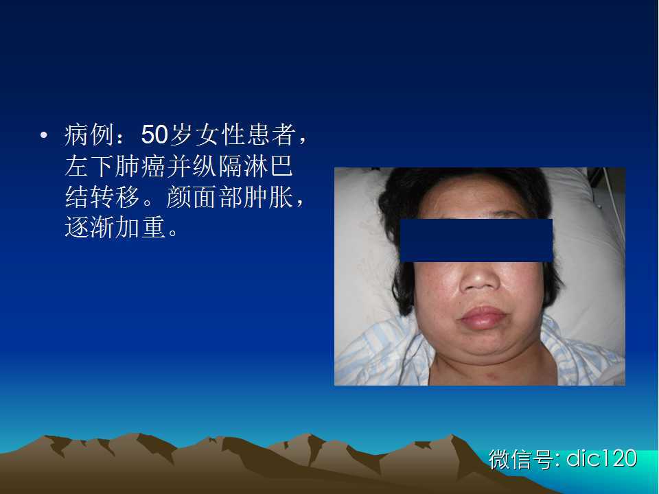 上腔静脉综合征影像诊断及介入治疗