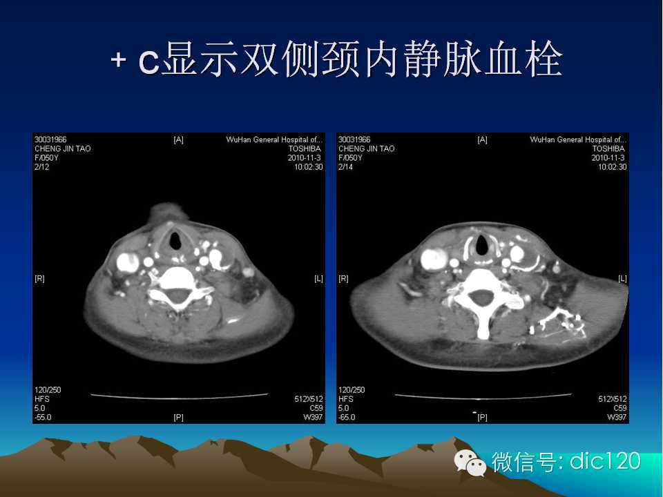 上腔静脉综合征影像诊断及介入治疗
