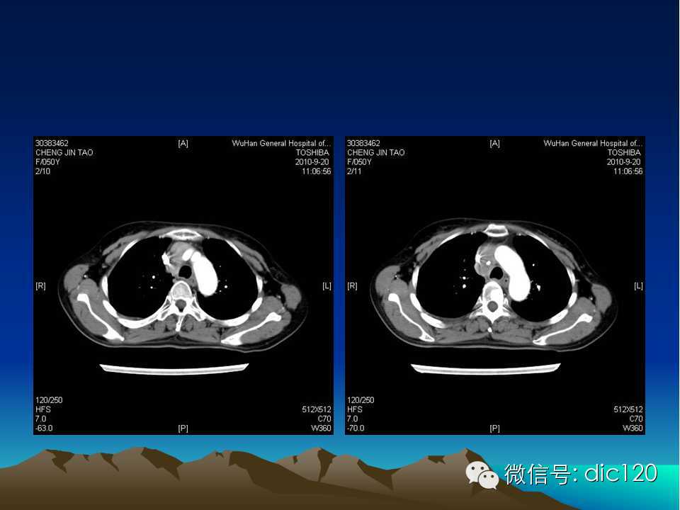 上腔静脉综合征影像诊断及介入治疗