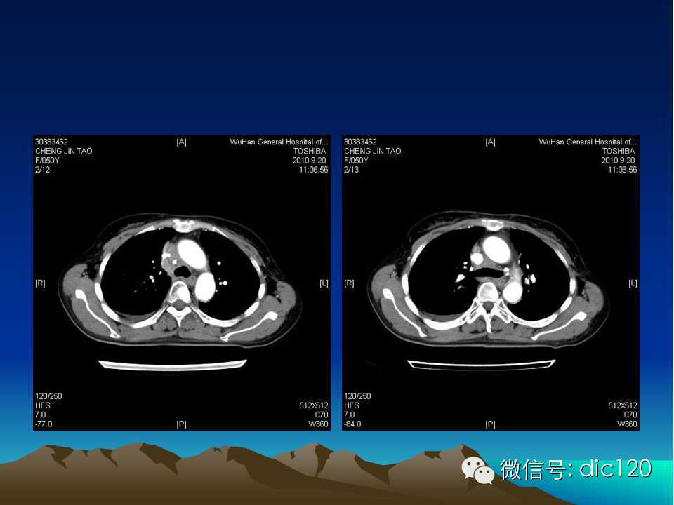 上腔静脉综合征影像诊断及介入治疗