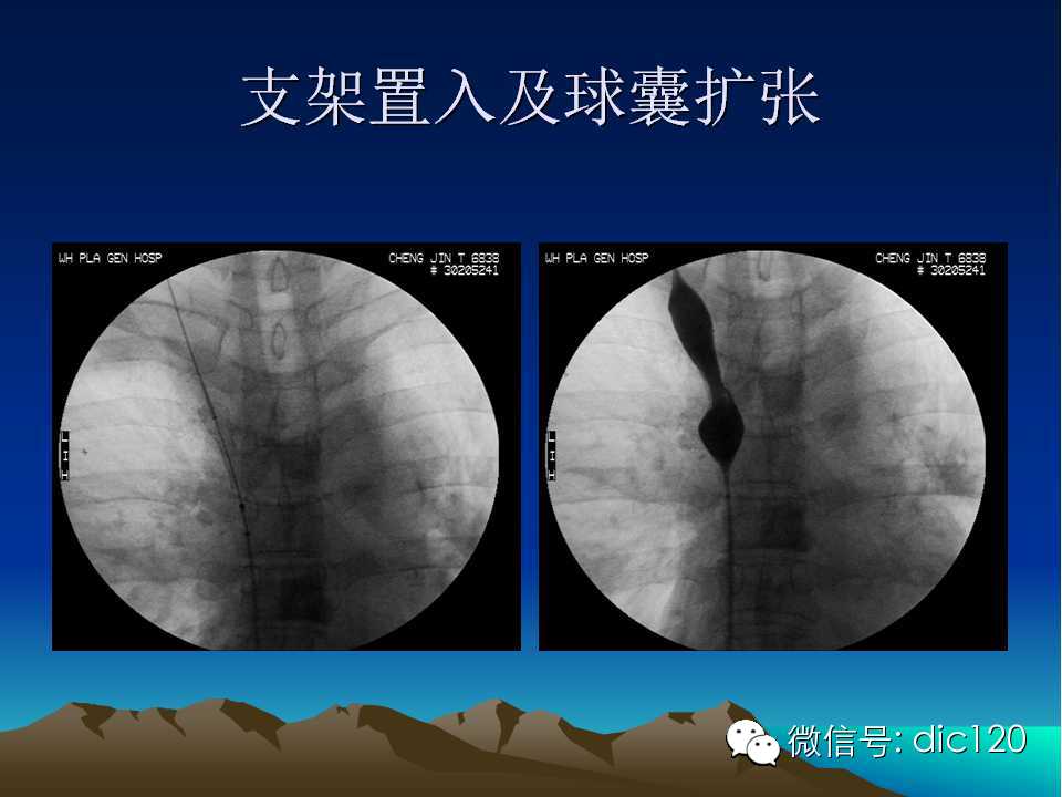 上腔静脉综合征影像诊断及介入治疗
