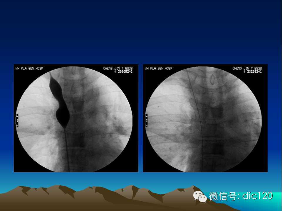上腔静脉综合征影像诊断及介入治疗
