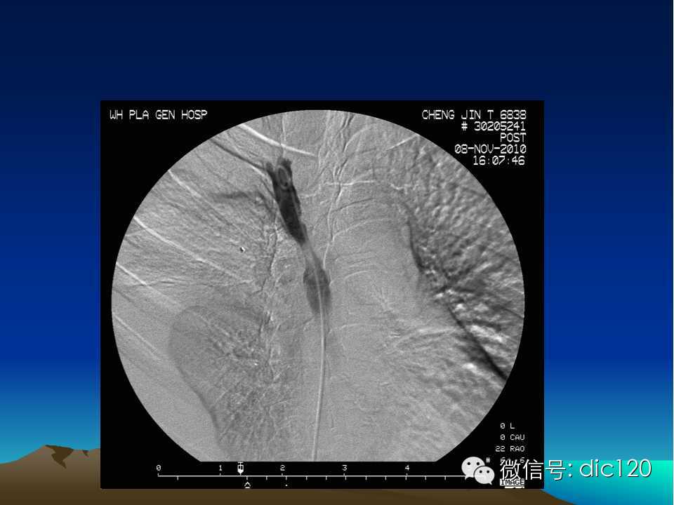 上腔静脉综合征影像诊断及介入治疗