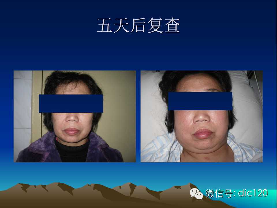 上腔静脉综合征影像诊断及介入治疗