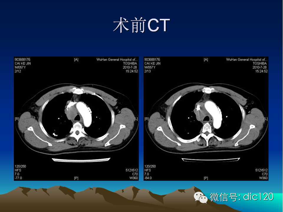 上腔静脉综合征影像诊断及介入治疗