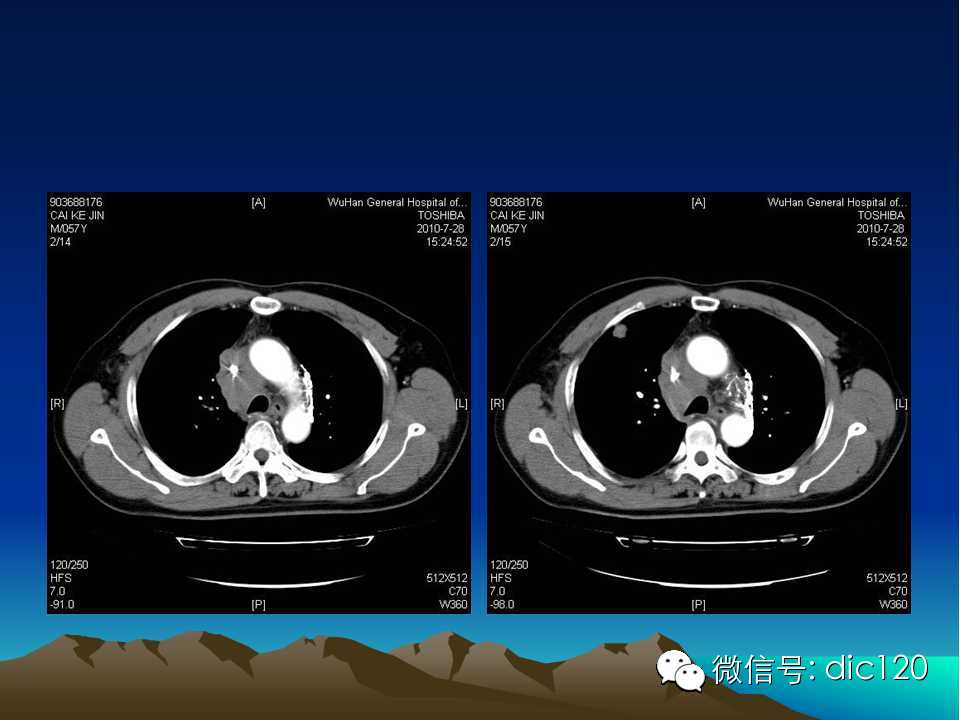 上腔静脉综合征影像诊断及介入治疗