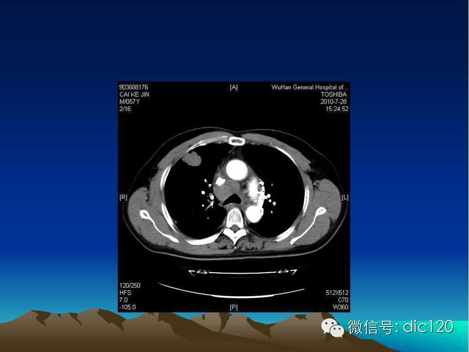 上腔静脉综合征影像诊断及介入治疗