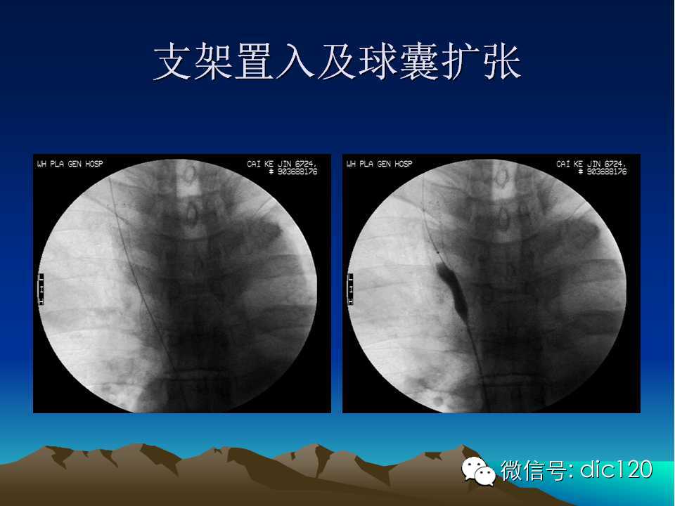 上腔静脉综合征影像诊断及介入治疗