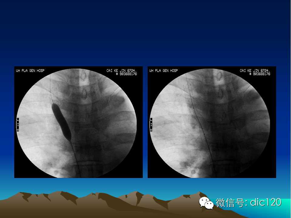 上腔静脉综合征影像诊断及介入治疗