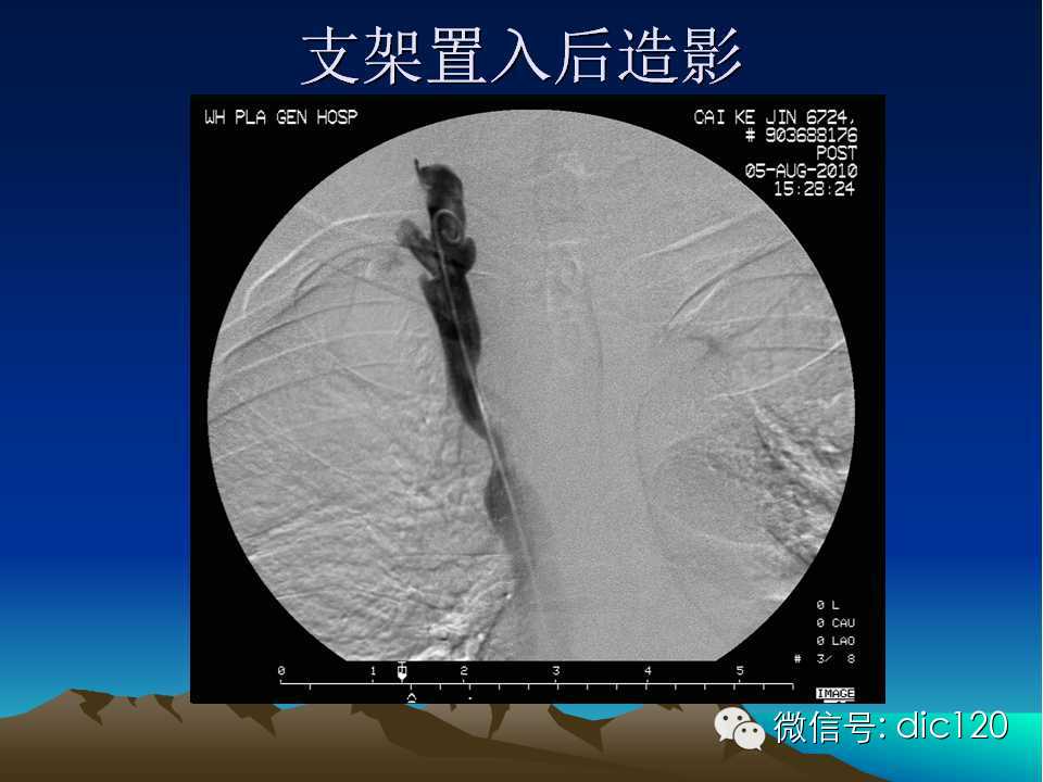 上腔静脉综合征影像诊断及介入治疗