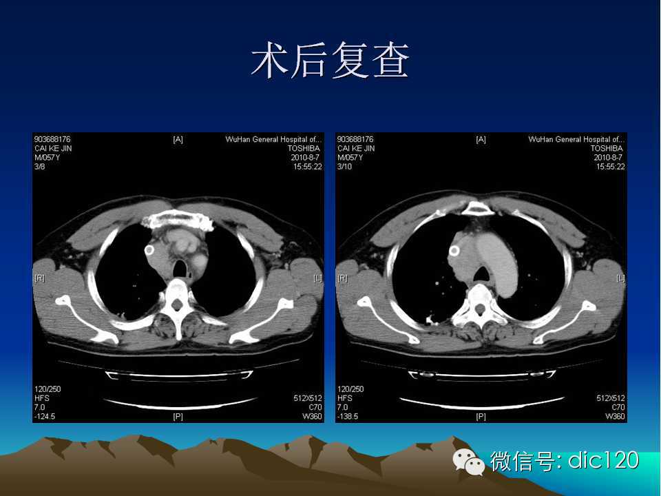 上腔静脉综合征影像诊断及介入治疗