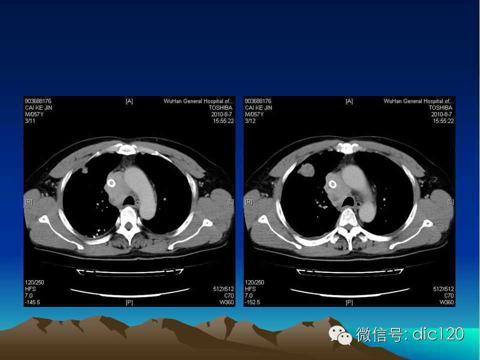 上腔静脉综合征影像诊断及介入治疗