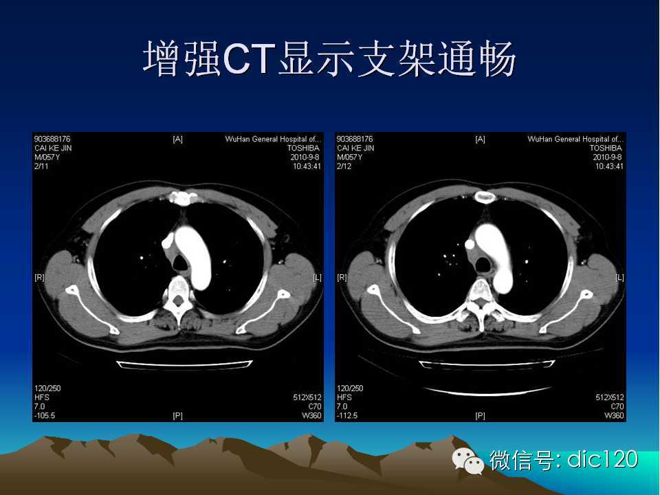 上腔静脉综合征影像诊断及介入治疗