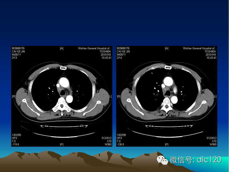 上腔静脉综合征影像诊断及介入治疗