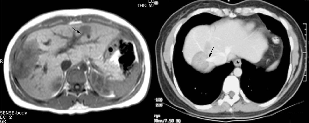 MRI(棒棒糖征).jpg