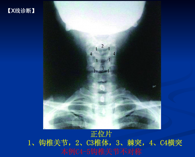 脊柱影像阅读入门