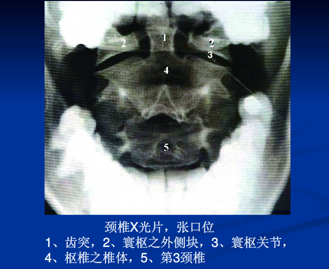 脊柱影像阅读入门