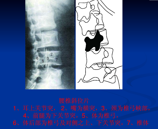 脊柱影像阅读入门