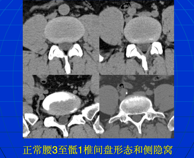 脊柱影像阅读入门