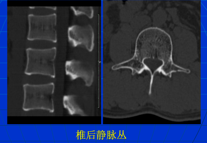 脊柱影像阅读入门