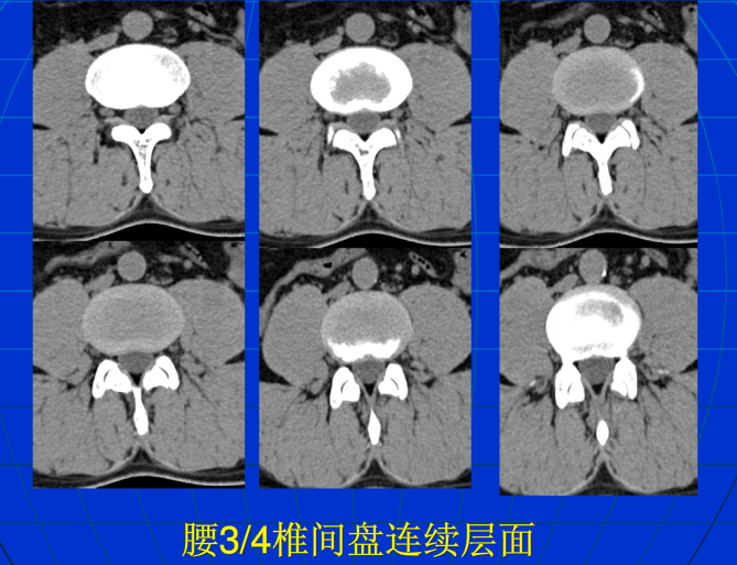 脊柱影像阅读入门