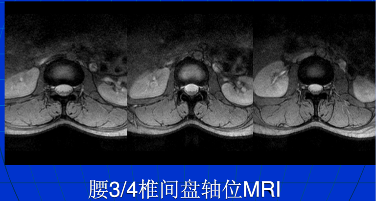 脊柱影像阅读入门