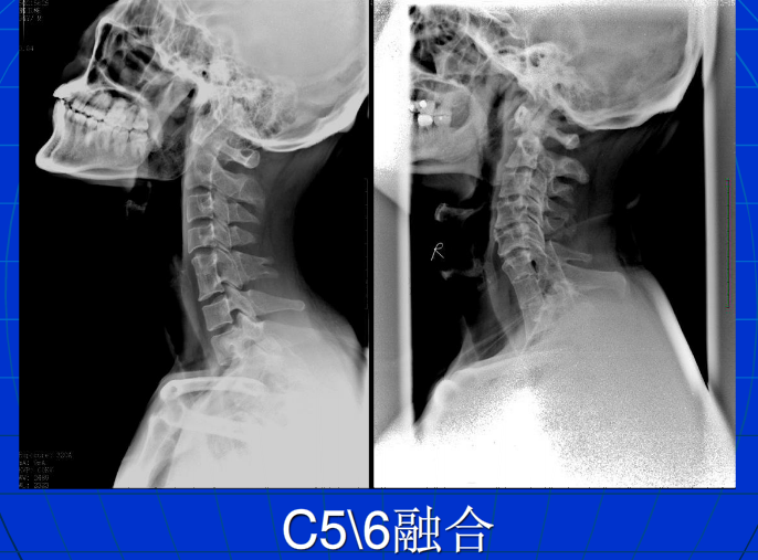 脊柱影像阅读入门
