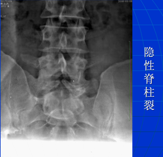 脊柱影像阅读入门