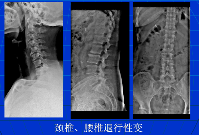 脊柱影像阅读入门