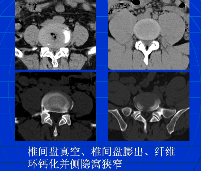 脊柱影像阅读入门